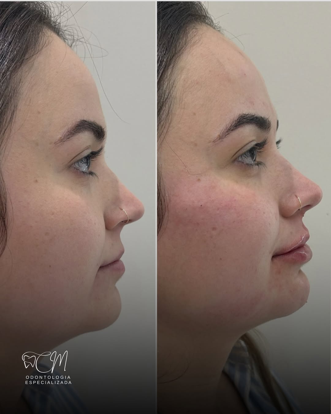 Harmonização Orofacial — antes e depois
